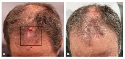 Case report: Regression of in-transit metastases of cutaneous squamous cell carcinoma with combination pembrolizumab and topical diphencyprone